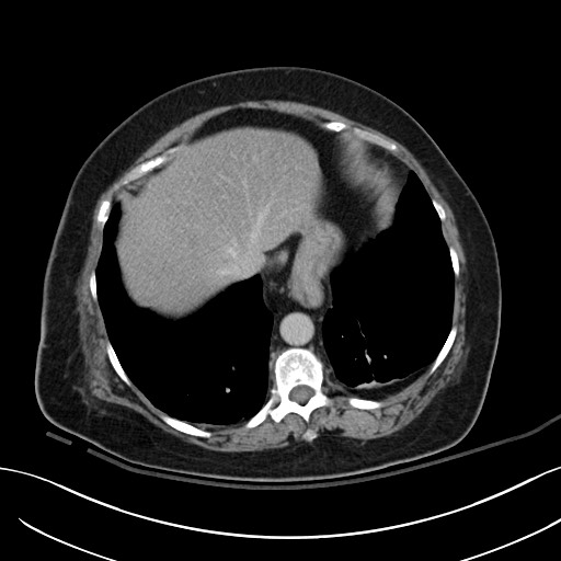 File:Breast carcinoma with pathological hip fracture (Radiopaedia 60314-67974 B 9).jpg