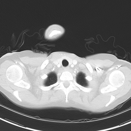 File:Bronchial atresia (Radiopaedia 73677-84470 Axial lung window 7).jpg