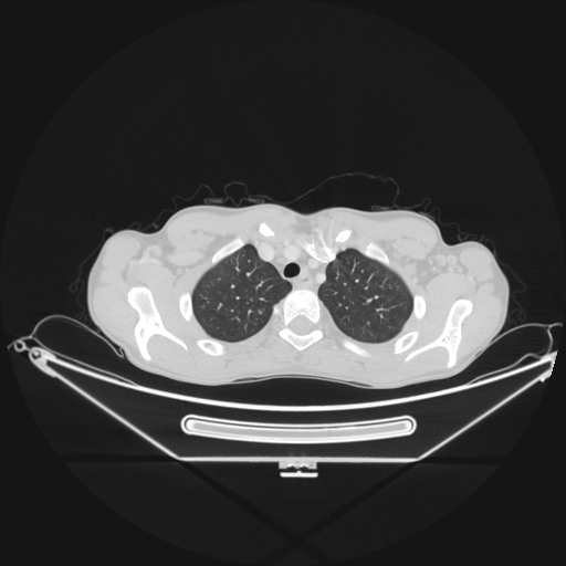 Bronchial carcinoid tumor (Radiopaedia 57187-64090 Axial lung window 11).jpg