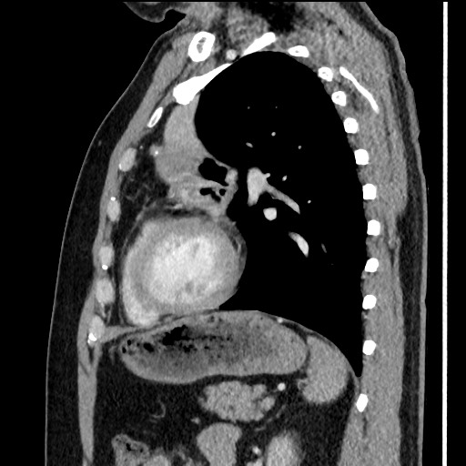 Bronchial carcinoid tumor (Radiopaedia 67377-76764 E 47).jpg