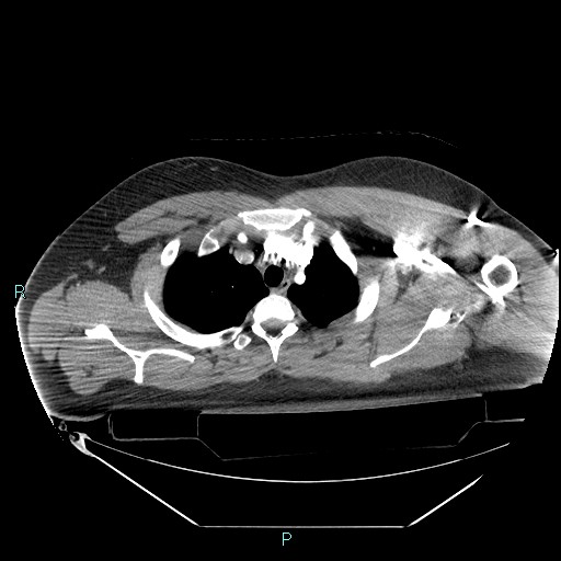 Bronchial carcinoid tumor (Radiopaedia 78272-90870 B 28).jpg