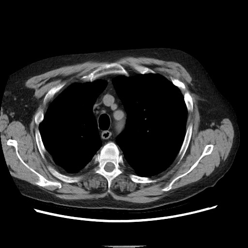 Bronchial stenosis - lung transplant (Radiopaedia 73133-83848 Axial non-contrast 17).jpg