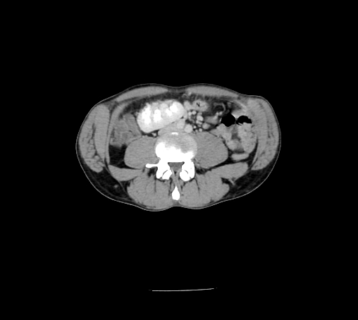 File:Bronchiectasis in Crohn disease (Radiopaedia 60311-67977 B 100).jpg