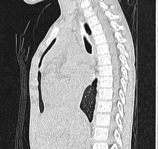 Bronchiolitis obliterans (Radiopaedia 71538-81897 Sagittal lung window 31).jpg