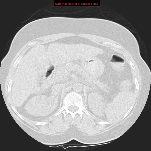 Bronchoalveolar carcinoma (Radiopaedia 13224-13233 Axial lung window 52).jpg