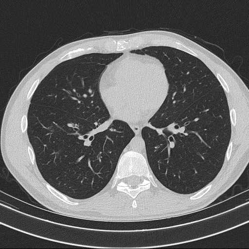 Bronchocele (Radiopaedia 60676-68429 Axial lung window 45).jpg