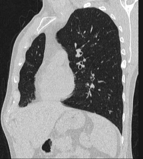 File:Bronchocele (Radiopaedia 60676-68429 Oblique lung window 5).jpg