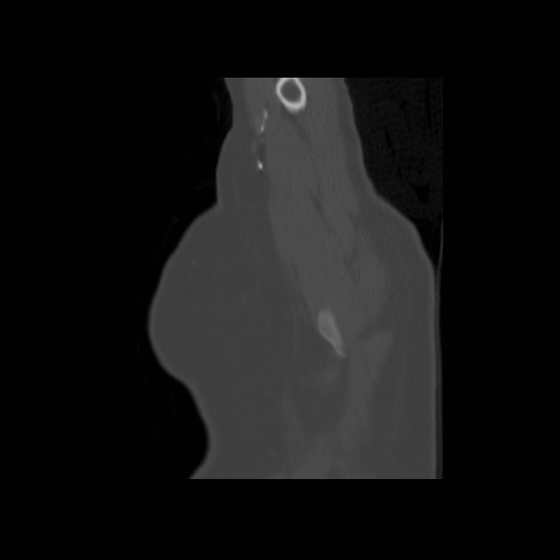 Bronchogenic carcinoma (Radiopaedia 73497-84262 Sagittal bone window 14).jpg