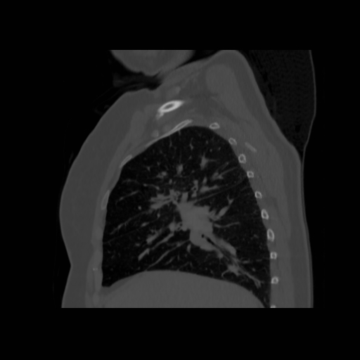 Bronchogenic carcinoma (Radiopaedia 73497-84262 Sagittal bone window 58).jpg