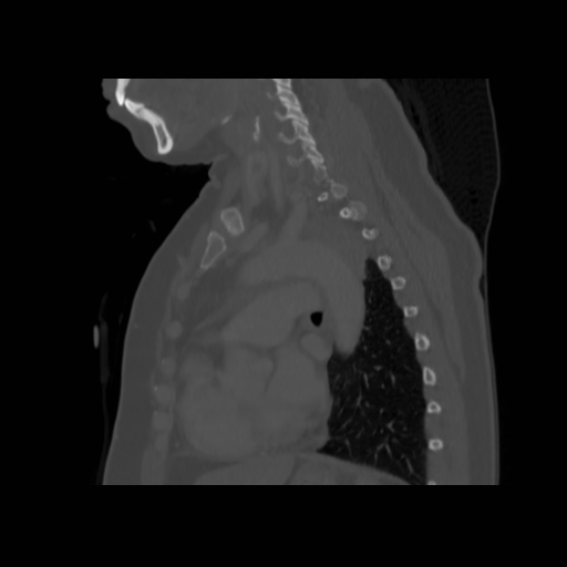 Bronchogenic carcinoma (Radiopaedia 73497-84262 Sagittal bone window 95).jpg