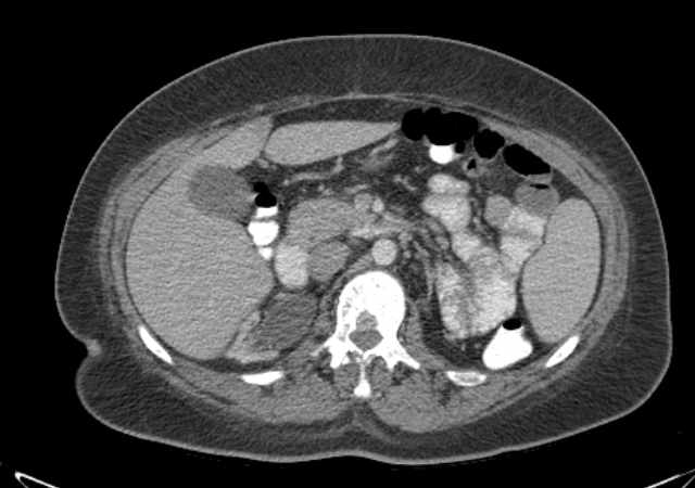 File:Brown tumors compressing the spinal cord (Radiopaedia 68442-77988 E 46).jpg