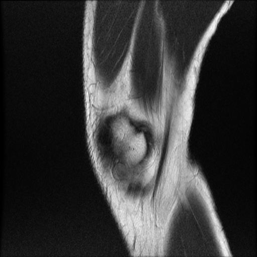 File:Bucket-handle meniscus tear (Radiopaedia 65700-74809 Sagittal T2 3).jpg