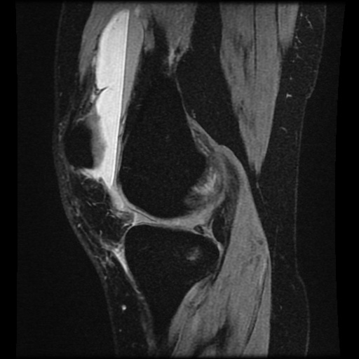 File:Bucket handle meniscus tear (Radiopaedia 56916-63751 H 53).jpg