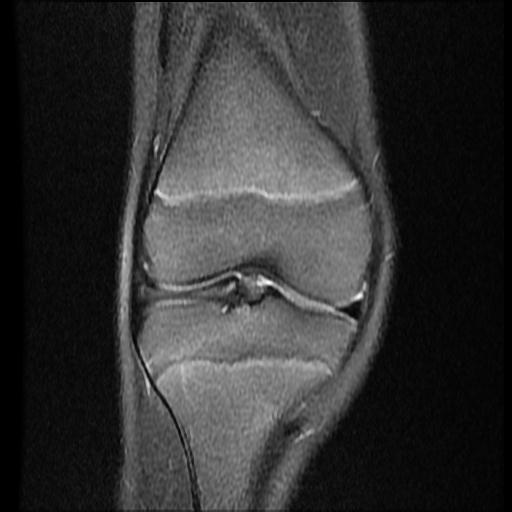 File:Bucket handle tear - lateral meniscus (Radiopaedia 72124-82634 Coronal PD fat sat 7).jpg