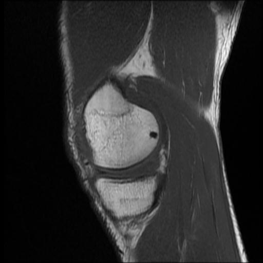 File:Bucket handle tear - medial meniscus (Radiopaedia 69245-79026 Sagittal T1 14).jpg
