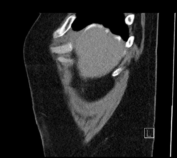 Buried bumper syndrome - gastrostomy tube (Radiopaedia 63843-72577 Sagittal Inject 110).jpg