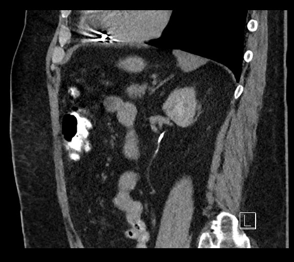 Buried bumper syndrome - gastrostomy tube (Radiopaedia 63843-72577 Sagittal Inject 39).jpg