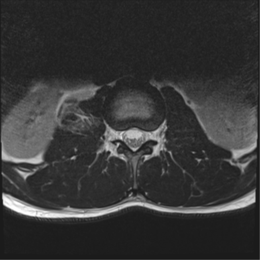 File:Burst fracture - T12 with conus compression (Radiopaedia 56825-63646 Axial T2 4).png