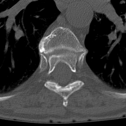 Butterfly vertebrae with kyphoscoliosis (Radiopaedia 14257-14133 Axial bone window 17).jpg