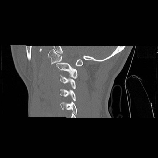 File:C1-C2 "subluxation" - normal cervical anatomy at maximum head rotation (Radiopaedia 42483-45607 C 18).jpg