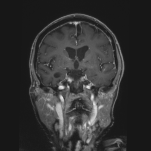 CNS lymphoma with steroid response (Radiopaedia 37980-39921 Coronal T1 C+ 20).png