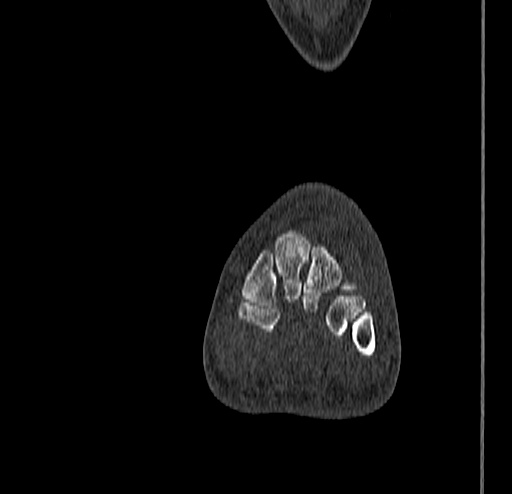File:Calcaneal fracture - Sanders type 4 (Radiopaedia 90179-107370 Coronal bone window 44).jpg
