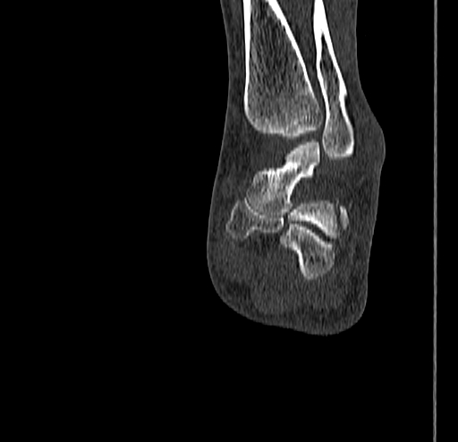 Calcaneal fracture - Sanders type 4 (Radiopaedia 90179-107370 Coronal bone window 59).jpg