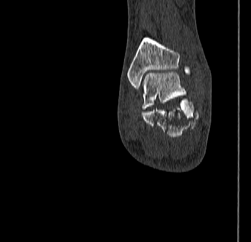 Calcaneal fracture - Sanders type 4 (Radiopaedia 90179-107370 Coronal bone window 69).jpg