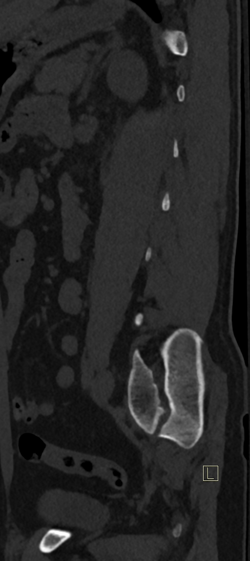 Calcaneal fractures with associated L2 burst fracture (Radiopaedia 71671-82493 Sagittal bone window 10).jpg