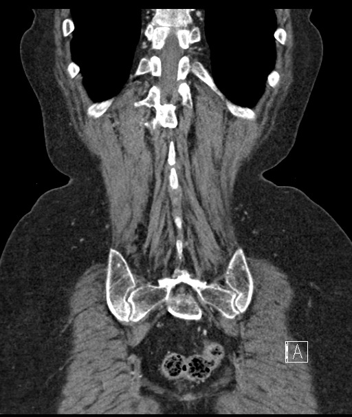 Calcified adrenal glands and Spigelian hernia (Radiopaedia 49741-54988 B 102).jpg