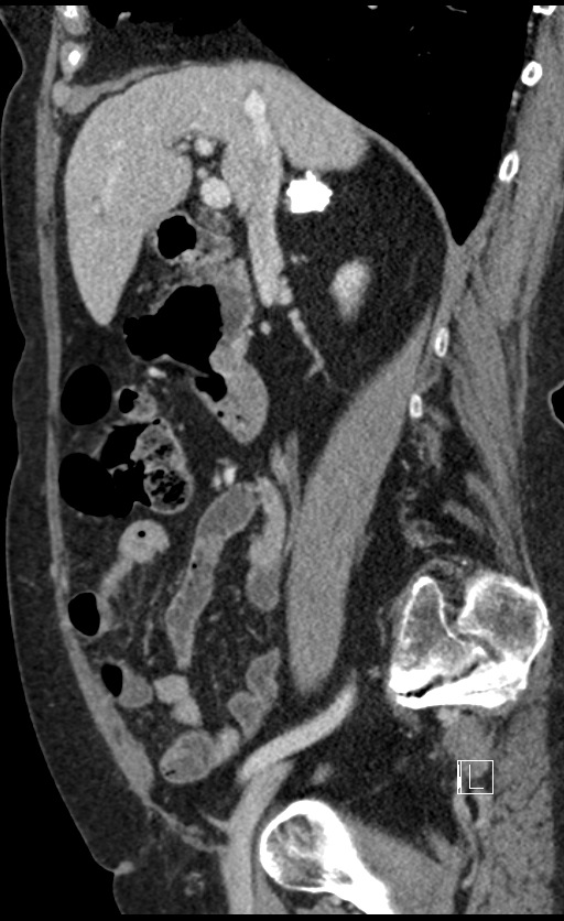 Calcified adrenal glands and Spigelian hernia (Radiopaedia 49741-54988 C 103).jpg