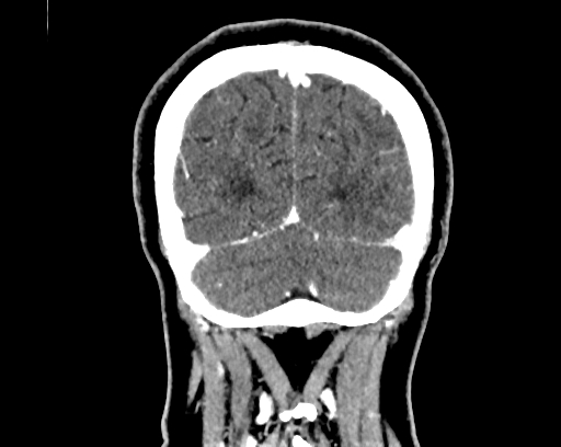 Calcified cerebral hydatid cyst (Radiopaedia 65603-74717 C 64).jpg