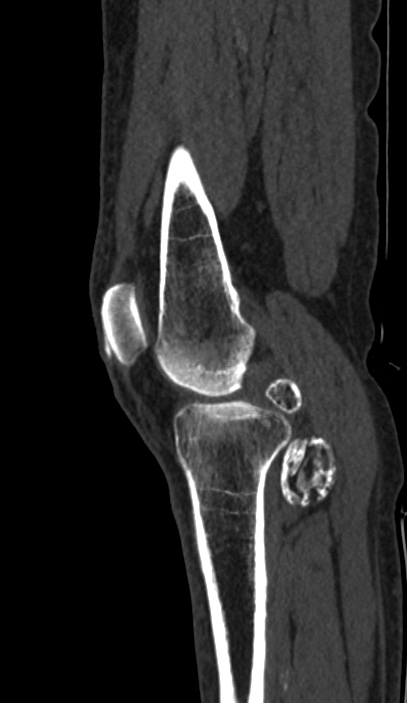 Calcified hematoma - popliteal fossa (Radiopaedia 63938-72763 Sagittal bone window 16).jpg