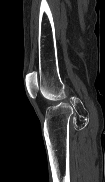Calcified hematoma - popliteal fossa (Radiopaedia 63938-72763 Sagittal bone window 60).jpg