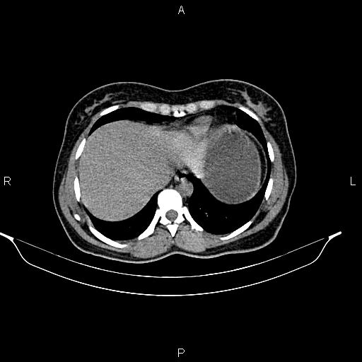 File:Calcified hepatic hydatid cyst (Radiopaedia 84672-100095 Axial non-contrast 16).jpg