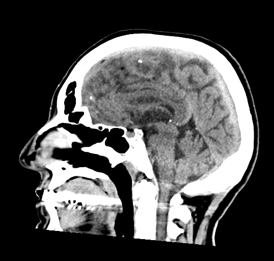 File:Calcified meningioma (Radiopaedia 74361-85243 D 2).jpg