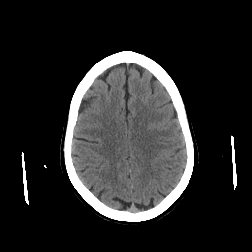 File:Calcified meningioma - cervical canal (Radiopaedia 70136-80171 Axial non-contrast 19).jpg