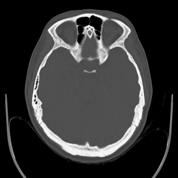 Calvarial osteoma (Radiopaedia 36520-38079 Axial bone window 37).jpg
