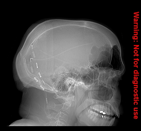 File:Calvarial thickening from chronic shunting (Radiopaedia 60079-67636 Lateral 1).jpg