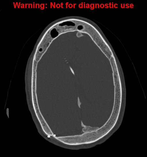 File:Calvarial thickening from chronic shunting (Radiopaedia 60079-67637 Axial bone window 125).jpg