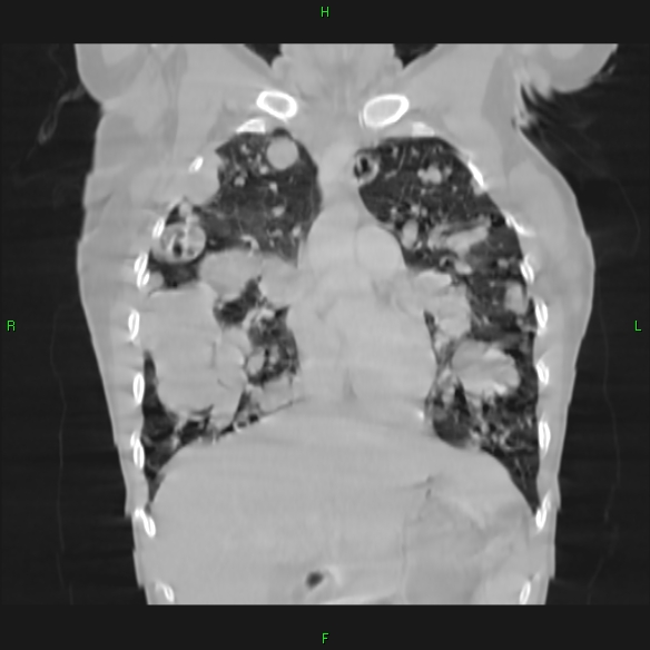 File:Cannon ball metastases - synovial sarcoma (Radiopaedia 26135-26271 Coronal lung window 5).jpg
