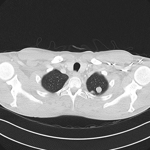 Cannonball metastases - testicular choriocarcinoma (Radiopaedia 84510-99891 Axial lung window 13).jpg