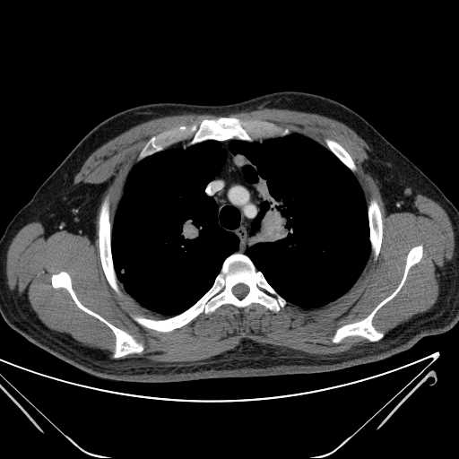 File:Cannonball pulmonary metastases (Radiopaedia 67684-77101 D 75).jpg
