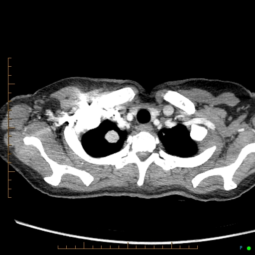 Canonball lung metastasis (Radiopaedia 77634-89837 B 6).jpg