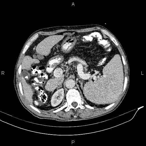 Caput medusae sign - portal hypertension (Radiopaedia 64007-72759 A 21).jpg