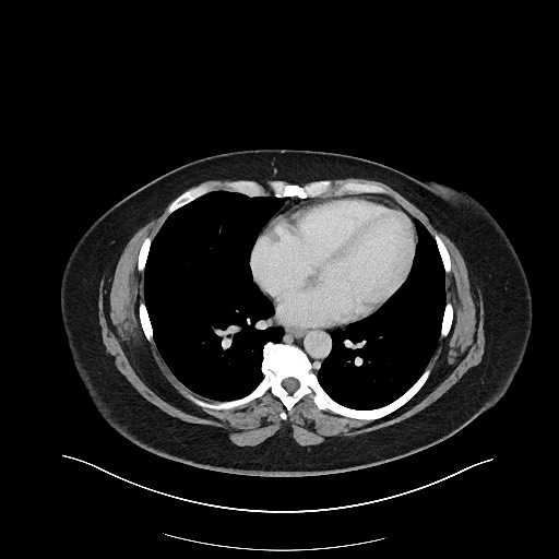 File:Carcinoid tumor - terminal ileum (Radiopaedia 60931-68739 A 1).jpg
