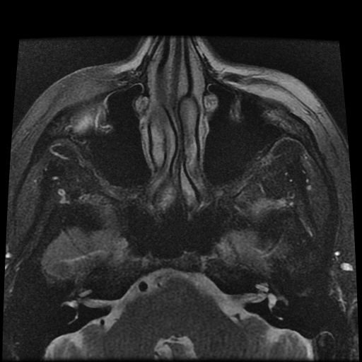 File:Carcinoid tumor of the ileum with metastasis to orbit (Radiopaedia 28165-28424 Axial T2 4).jpg