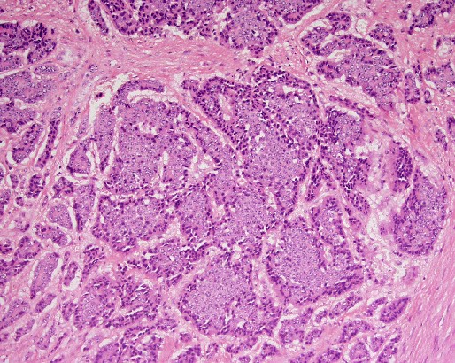 File:Carcinoid tumor of the ileum with metastasis to orbit (Radiopaedia 28165-28426 H&E 1).jpg