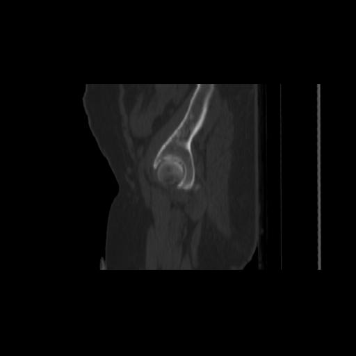 File:Carcinoma cervix- brachytherapy applicator (Radiopaedia 33135-34173 Sagittal bone window 14).jpg