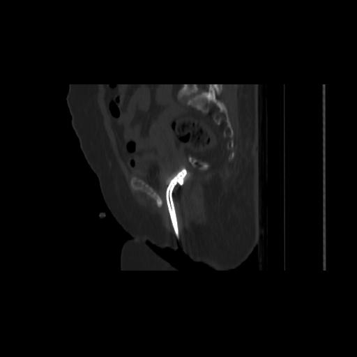 Carcinoma cervix- brachytherapy applicator (Radiopaedia 33135-34173 Sagittal bone window 74).jpg